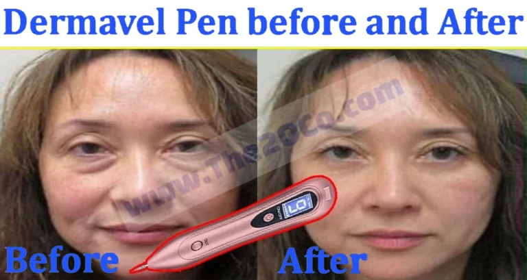 Dermavel Plasma Pen Reviews: How Does it Really Work?