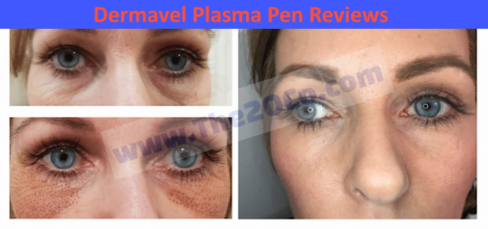 Dermavel Plasma Pen Reviews