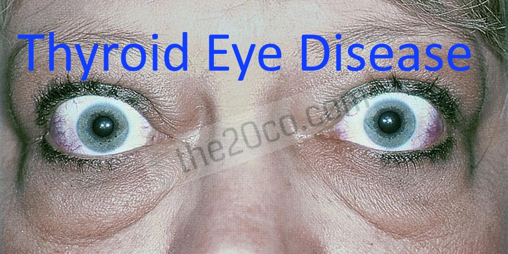 Thyroid Eye Disease