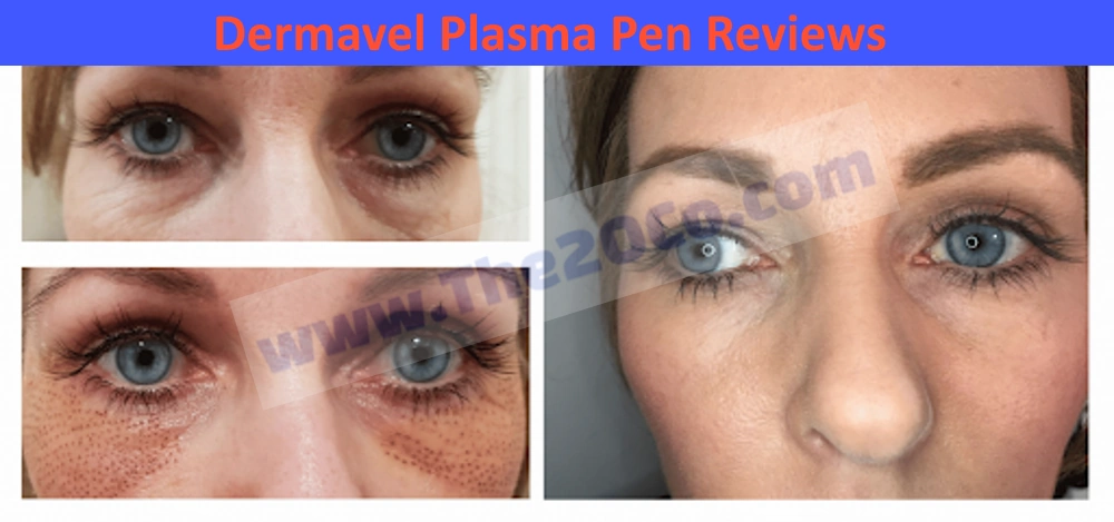 Dermavel Plasma Pen Reviews: Ultimate Guide to Radiant Skin