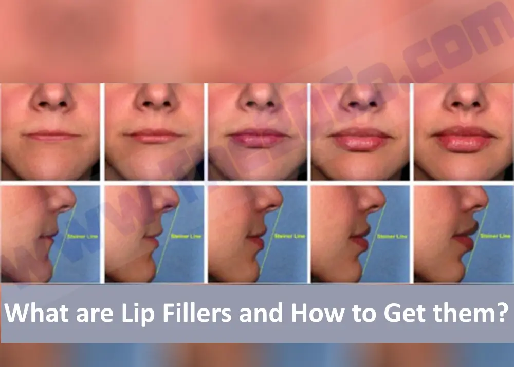 What are Lip Fillers and How to Get them?